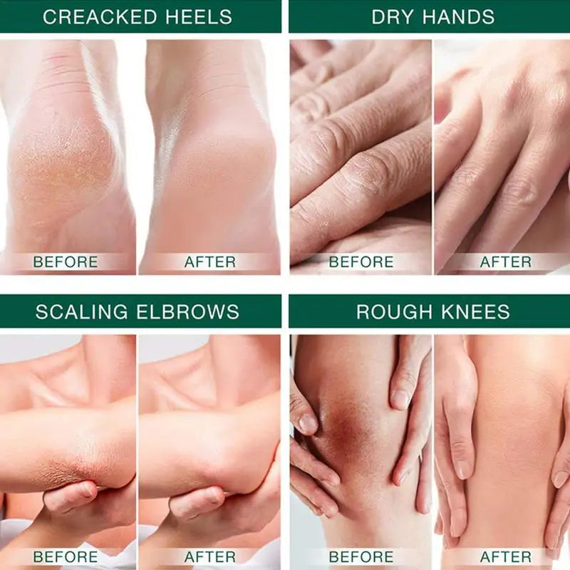 Crème Urea 42% pour pieds secs et callosités